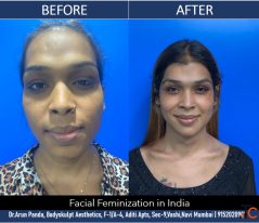 Explore Facial Feminization Surgery in Mumbai with Personalized Surgical Planning