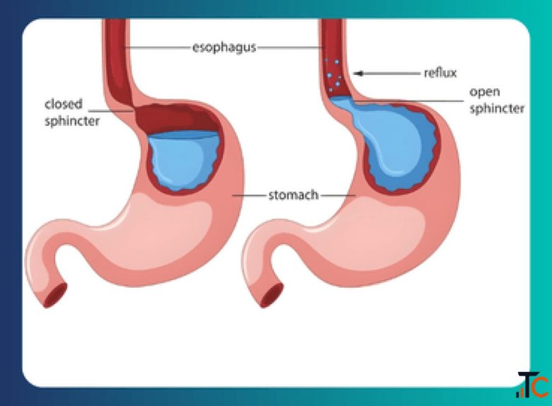 Acid Reflux Treatment in South Delhi - Expert Care