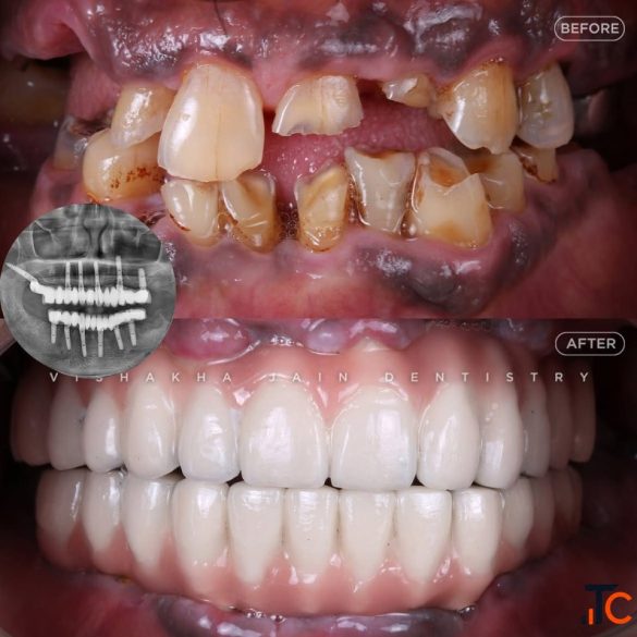 Dental Implant in Indore Best Dental Implant Treatment Care