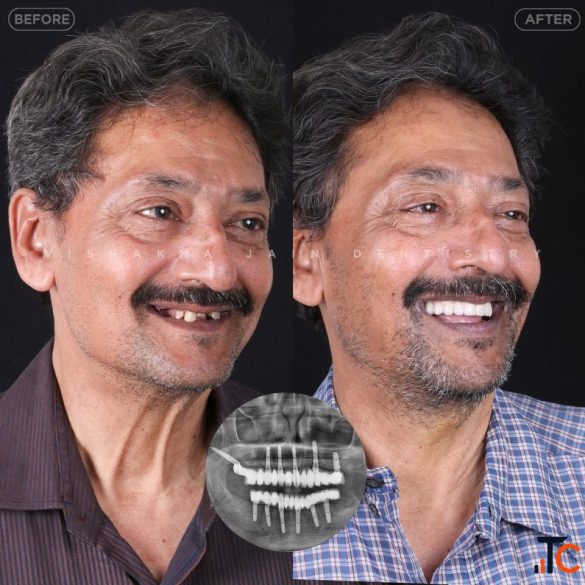 Dental Implant in Indore Best Dental Implant Treatment Care