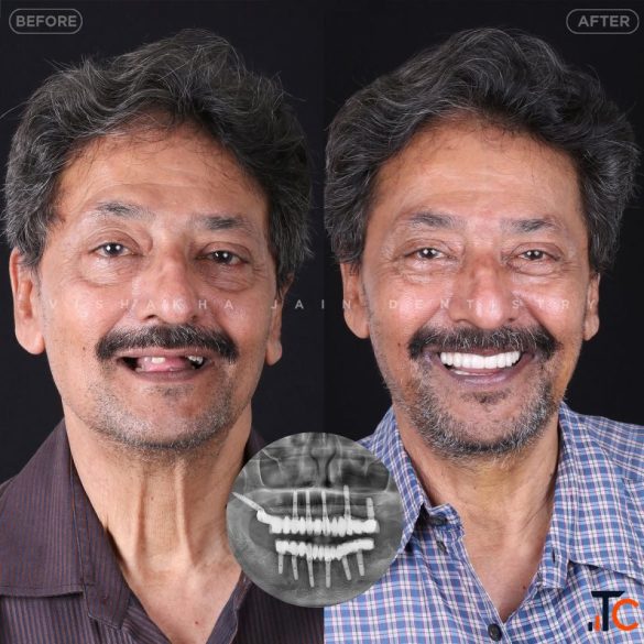 Dental Implant in Indore Best Dental Implant Treatment Care
