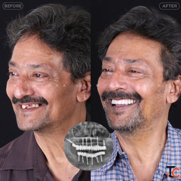Dental Implant in Indore Best Dental Implant Treatment Care