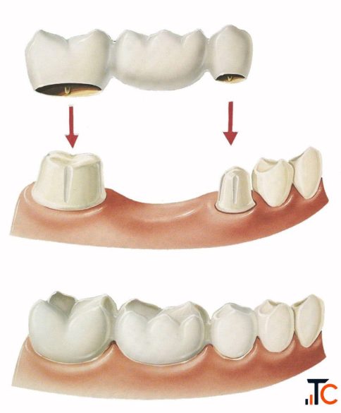 Trusted Brooklyn Dentist Natural-Looking Crowns Bridges