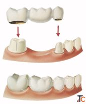 Trusted Brooklyn Dentist Natural-Looking Crowns Bridges