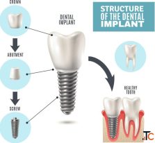 Restore Your Smile with Oxnard Dental Implants