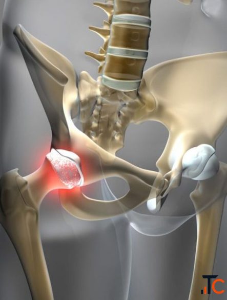 Expert Hip Replacement Care for Better Mobility in Panchkula