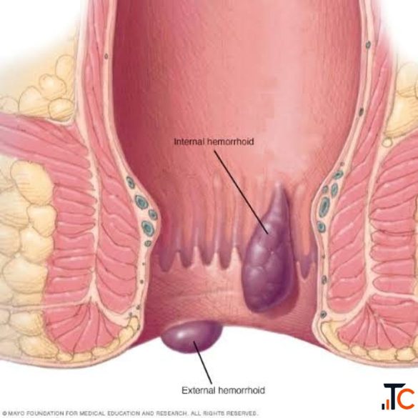 Trusted Piles Surgeon in Delhi Expert Piles Treatment
