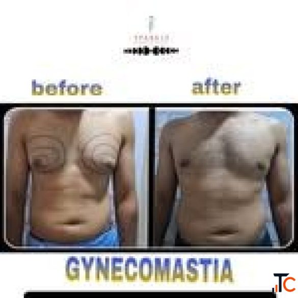 breast augmentation in mumbai