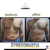 breast augmentation in mumbai