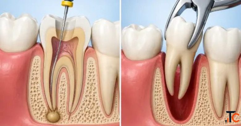Root Canal or Extraction A Tooth-Saving Decision Guide