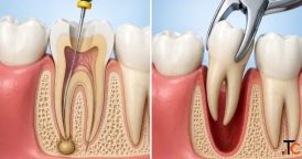 Root Canal or Extraction A Tooth-Saving Decision Guide