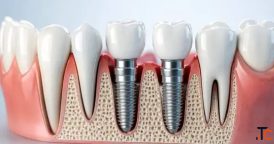 Implants vs. Bridge Which Option Fits You