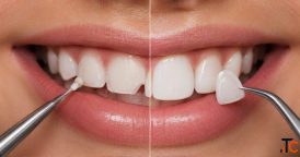 Bonding vs Veneers for Chips and Gaps La Quinta