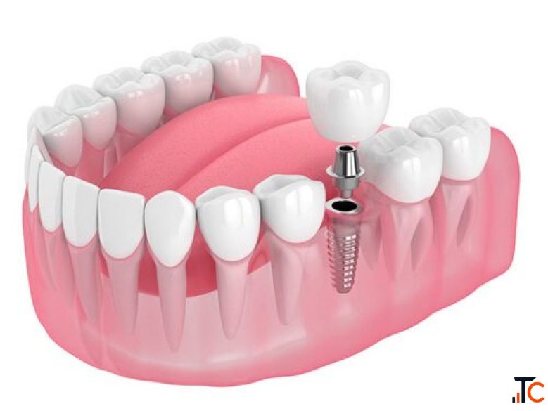Best Dental Implant Cost in India