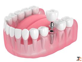 Best Dental Implant Cost in India