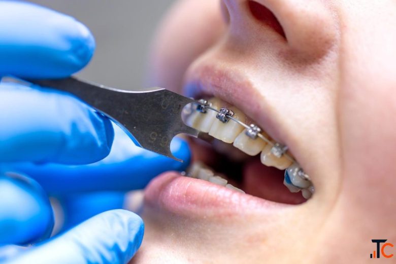 Teeth Braces Cost in India