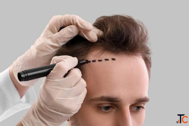 Sydney's Go-To Clinic for Advanced Hair Restoration