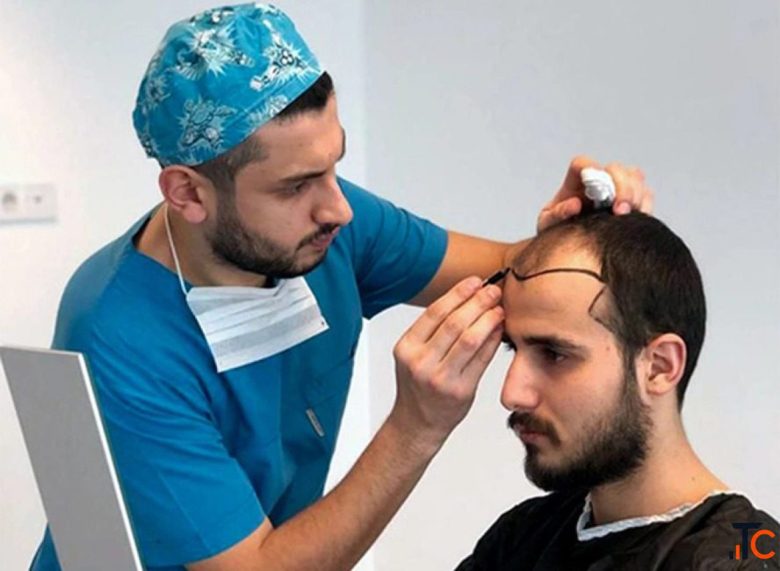 Hair Transplant in Noida Everything You Need to Know Before Getting Started