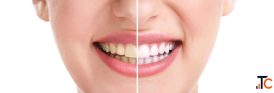 Why Are My Teeth Yellow Causes How to Whiten Them Safely