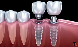 Replace Missing Teeth With Dental Implants The Dental Wellness Centre