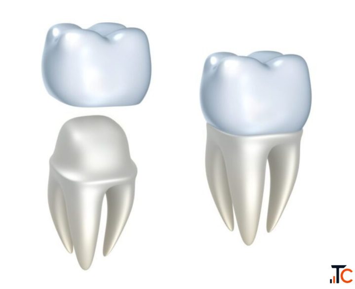 Need Dental Crowns in Oxnard Explore Your Options