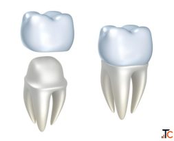 Need Dental Crowns in Oxnard Explore Your Options