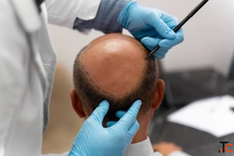 Transform Your Scalp with Dense Hair with Autologous Micrografting Treatment