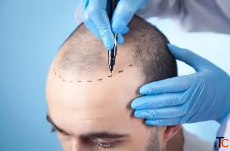 Trust the Best Hair Transplant Surgeon for Your Scalp