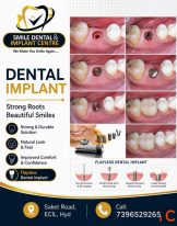 Missing Teeth Restore Your Natural Smile with Dental Implants in ECIL AS Rao Nagar