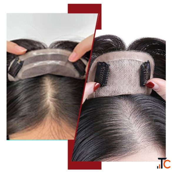 Non-Surgical Hair Replacement in Mumbai Andheri Infiniti