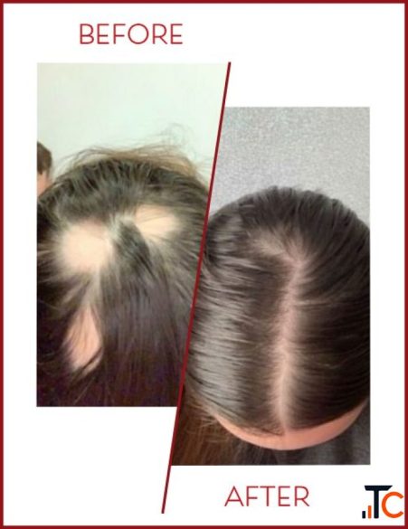 Clip on Hair System Service in Mumbai Infiniti Hair Club
