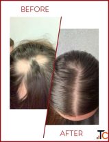 Clip on Hair System Service in Mumbai Infiniti Hair Club