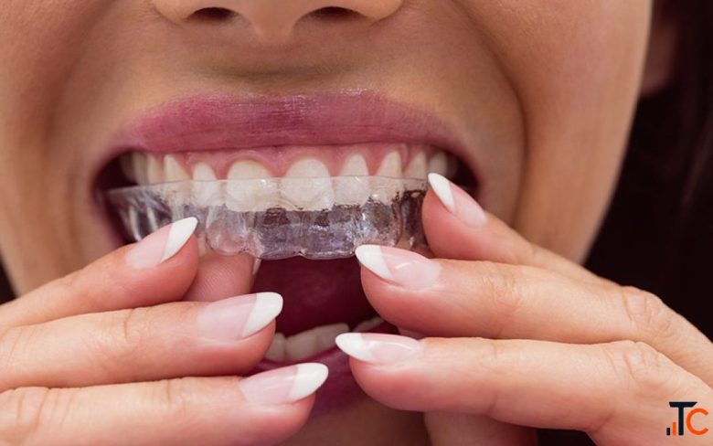 Night Guards Protecting Your Teeth from Bruxism