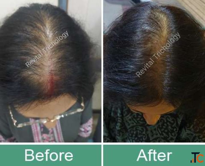 Personalized Hair and Scalp Treatments in Bandra