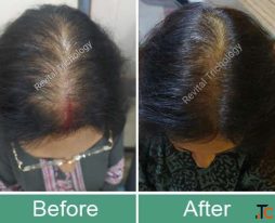 Personalized Hair and Scalp Treatments in Bandra