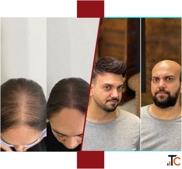 Best Hair Weaving services in Mumbai for Women Men Infiniti