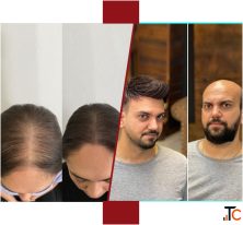 Best Hair Weaving services in Mumbai for Women Men Infiniti