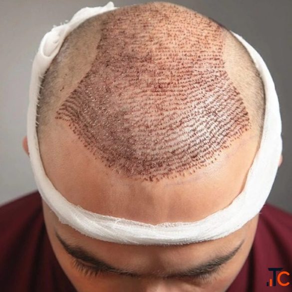 Hair Loss Scalp Treatment in Bannerghatta Road Bangalore