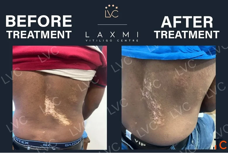 Homeopathic Vitiligo Treatment in Madurai Laxmi Vitiligo Centre