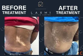 Homeopathic Vitiligo Treatment in Madurai Laxmi Vitiligo Centre