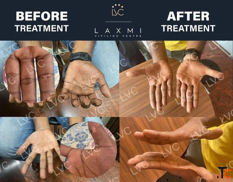 Homeopathic Vitiligo Treatment in Madurai Laxmi Vitiligo Centre