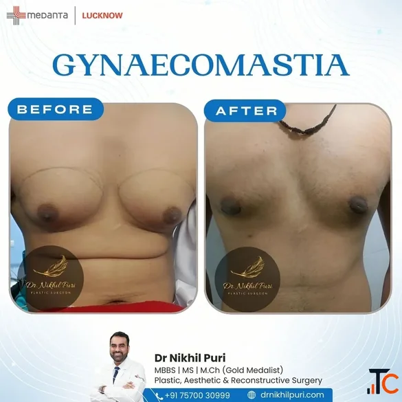 Gynecomastia Surgery in Lucknow - Male Breast Reduction by Dr Nikhil Puri