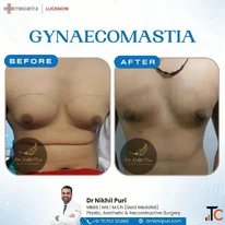 Gynecomastia Surgery in Lucknow - Male Breast Reduction by Dr Nikhil Puri