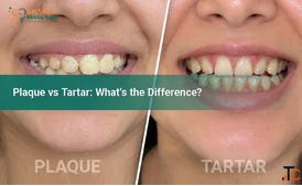 Plaque vs Tartar Key Differences The Shard Dental