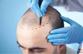 Restore Your Hair with a Male Hair Transplant in Germany