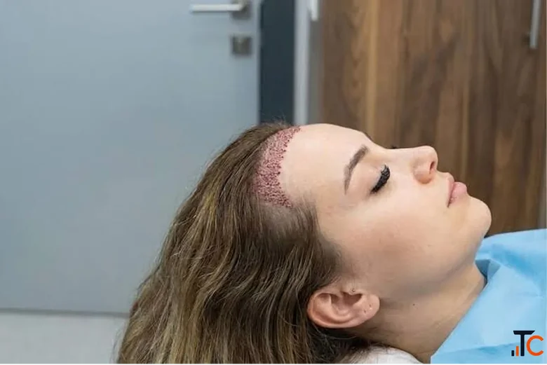 Choosing the Right Hair Transplant Surgeon in Germany