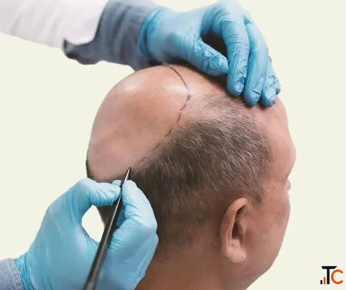 Choosing the Right Hair Transplant Surgeon in Germany