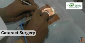 Cataract Treatment in Delhi - Eye Care Services