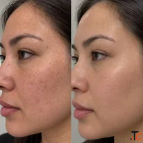 PRP Treatment in Toronto for Natural-Looking Skin Renewal