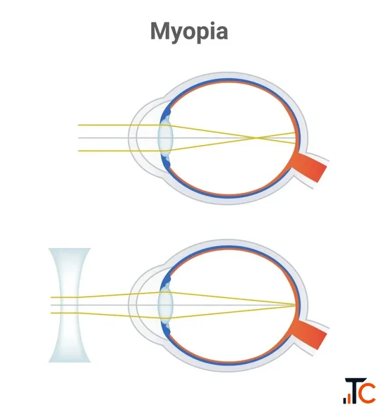 Trusted Myopia Treatment in Dehradun - Nivora Eye Hospital